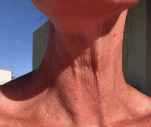 This is not a turkey. It is my neck.