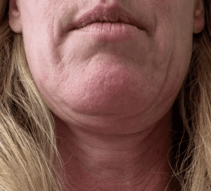 My chins